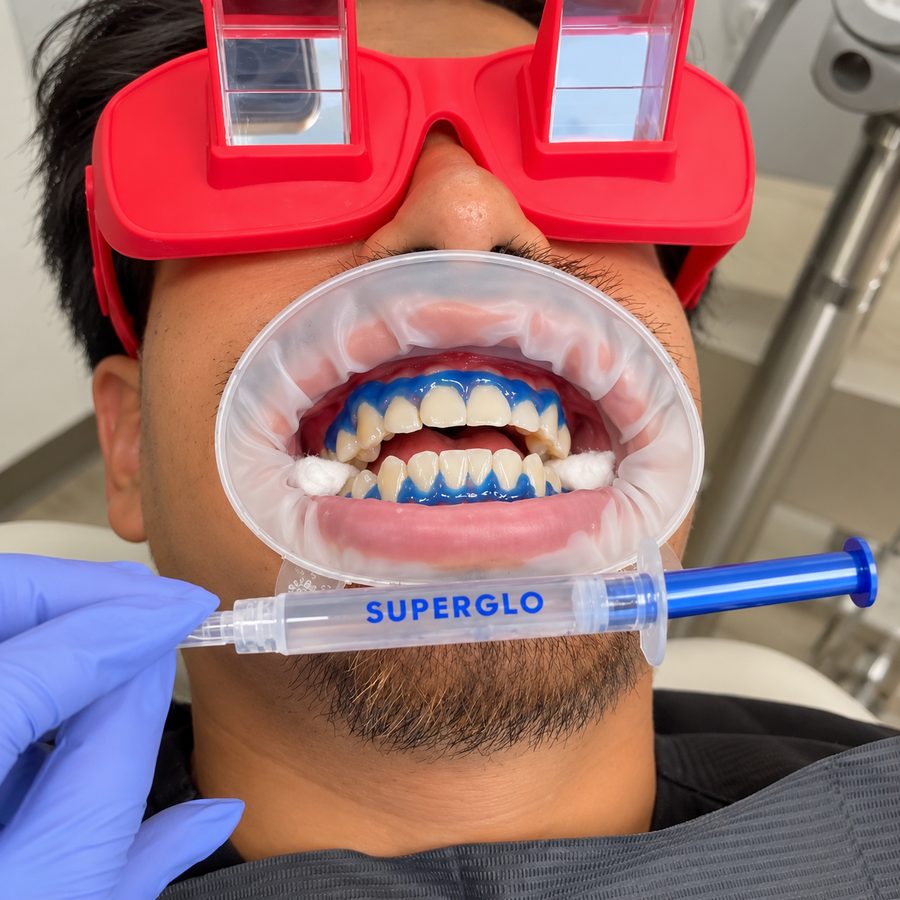 SuperGlo whitening gel being applied to a patient's teeth