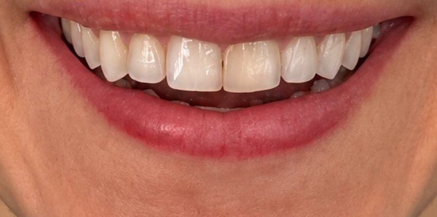 Smile before veneers, with small, uneven front teeth